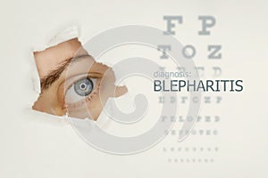 Blepharitis disease poster with eye test and blue eye on left. Studio grey background photo