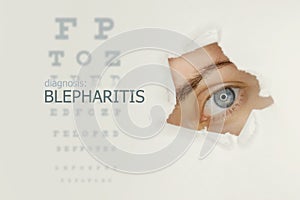 Blepharitis disease poster with eye test and blue eye on  right. photo