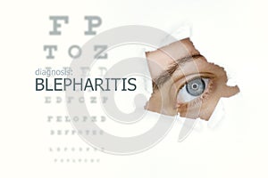 Blepharitis disease poster with eye test and blue eye on right photo