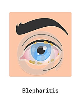 Blepharitis Human Eye Disease photo