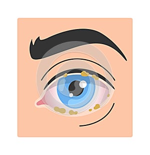 Blepharitis Human Eye Disease photo