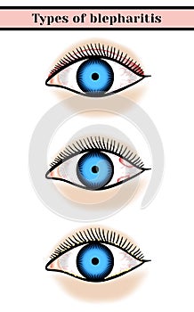 Blepharitis. Purulent, inflammatory eyes disease
