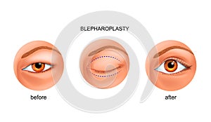 Blepharoplasty of the Asian eyelid