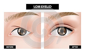 Blepharoplasty of eyelid