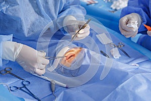 Blepharoplasty eyelid surgery with gloved surgeons suturing under sterile drapes