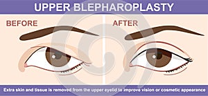 Blepharoplasty of eyelid , before and after. Vector illustration with double eyelid surgery. Infographics with icons of