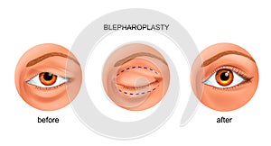 Blepharoplasty of the overhanging eyelid photo