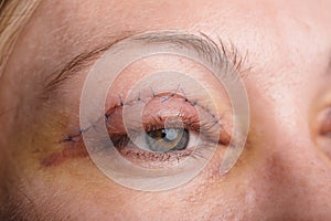 Blepharoplasty of the upper eyelid.