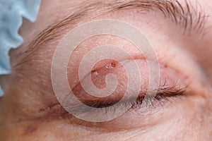 Blepharoplasty of the upper eyelid.