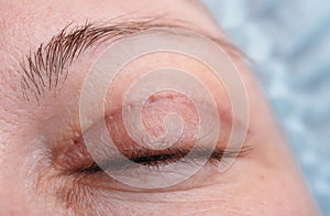 Blepharoplasty of the upper eyelid. photo