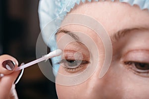 Blepharoplasty of the upper eyelid. photo