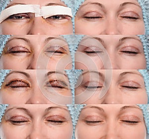 Blepharoplasty of the upper eyelid. photo