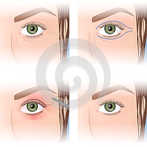 blepharoplasty, upper eyelid plastic, before and after images