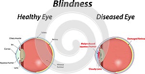 Blindness