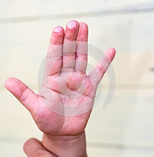 The blister on children finger caused by hot water injury