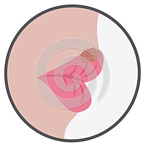 Blister on a lip of cold sores viral contageous infection