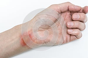 Blister made by boiling water  on young womanâ€˜s hand on isolated white, burn of a skin on femaleâ€™s wrist