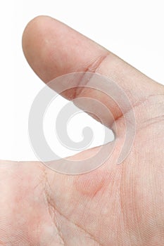 Blister on palm photo