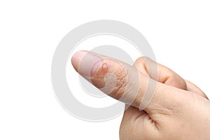 Blistering burn on finger