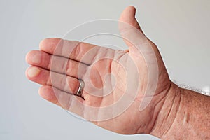 Blisters on two fingers of a man's hand photo