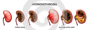 Blockage of the ureter . hydronephrosis.