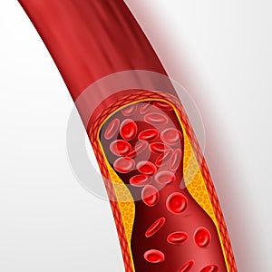 Blocked blood vessel, artery with cholesterol thrombus. 3d vein with clot vector illustration