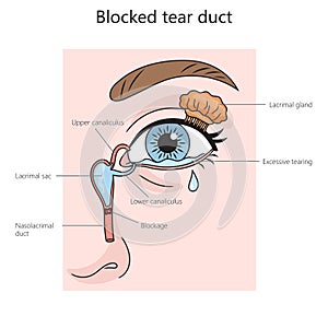 blocked tear duct diagram medical science