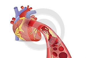 Blood cell can`t flow into human heart because clogged arteries by fatty.