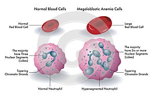 Blood cells with megaloblastic anemia