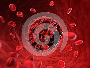 A blood clot