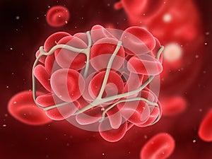 Blood clot