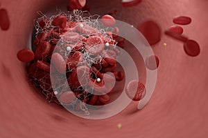 Blood clot blocking blood cells in artery