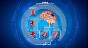 Blood clot in the brain