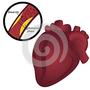 Blood clot cholesterol plaque in artery Heart attack