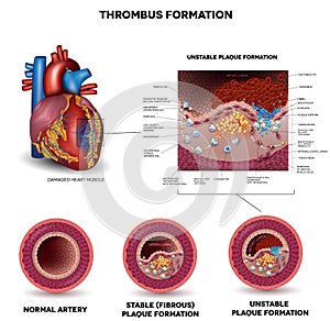 Blood clot formation