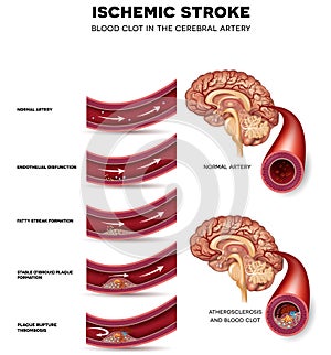 Blood clot formation in the cerebral artery