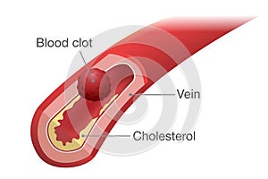 Blood clot occurs in a vein.