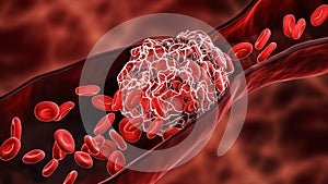 Blood Clot or thrombus blocking the red blood cells stream within an artery or a vein 3D rendering illustration. Thrombosis,