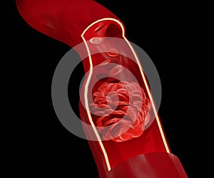 blood clot or thrombus is the final product of the blood coagulation step in hemostasis