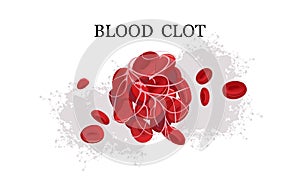 Blood clot thrombus medical poster