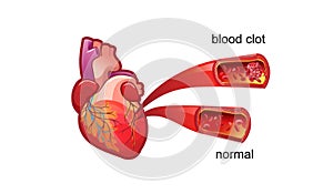 Blood clot thrombus medical poster