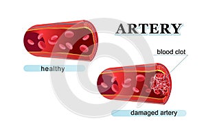 Blood clot thrombus medical poster