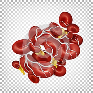 Blood clot. Thrombus. Red blood cells bound by fibrin filaments.