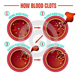 Blood clotting process