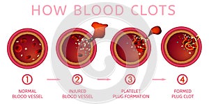 Blood clotting process photo