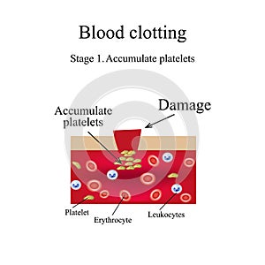 Blood clotting. Stage 1. Infographics. Vector illustration