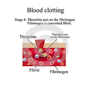Blood clotting. Stage 4. Infographics. Vector illustration