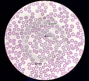 Blood film microscopic show decrease platelets leucocyte (WBC).