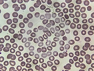 Blood film microscopic show decrease platelets leucocyte (WBC).
