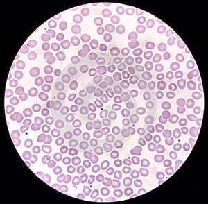 Blood film microscopic show decrease platelets leucocyte (WBC).
